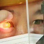 Bến Tre ghi nhận số người mắc đau mắt đỏ vượt ngưỡng 1.000 ca/ngày